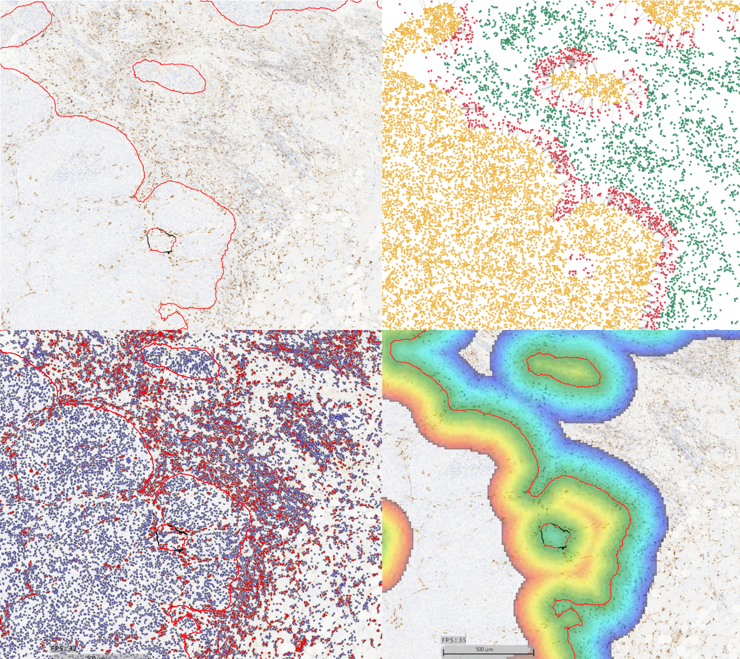 Infiltrationsanalyse von CD163+ Makrophagen in einer Kopf-Hals-Tumor Probe