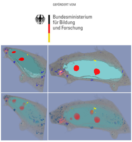 Strahlungsinduzierte Seneszenz: Blebs visualisiert durch 3D-Elektronenmikroskopie