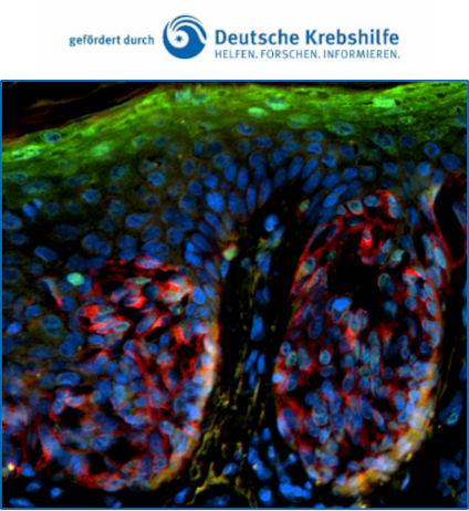 H2A.J-Expression in Melanomzellen 